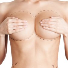 Breast Augmentation with Implants in Antalya